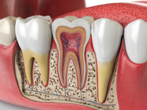 cracked tooth in Brentwood